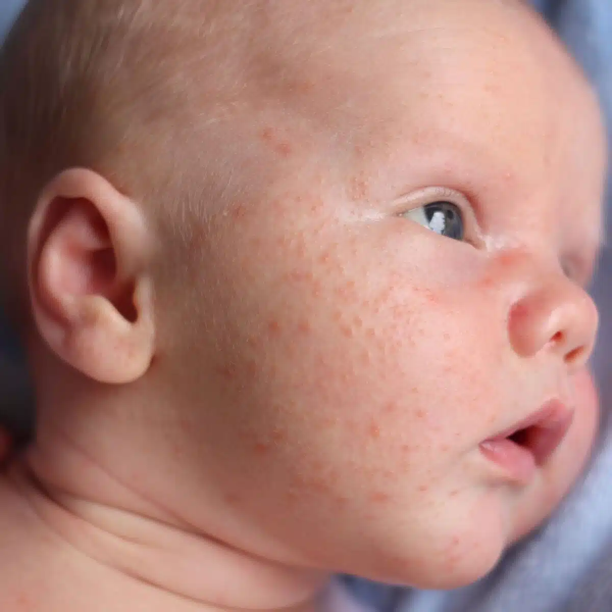Les allergies au lait bébé : symptômes et traitements